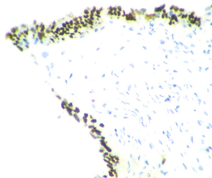 p53 signature - Continuous strong Nuclear positivity of tubal epithelium (IHC X400)