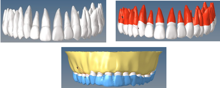 Maxilla bone model with teeth and aligner