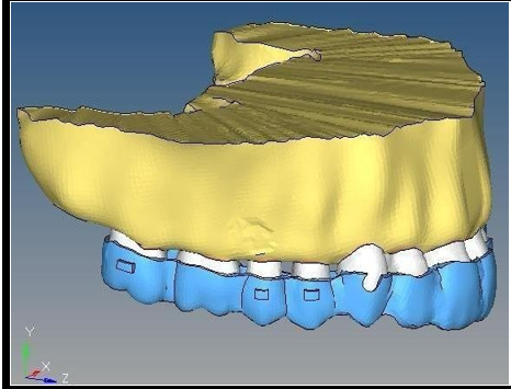 Maxillary model with precision cut present on the canine region of the aligner