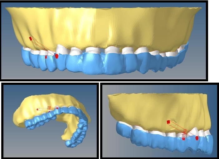Maxillary model with micro-implant and button for elastic attachment