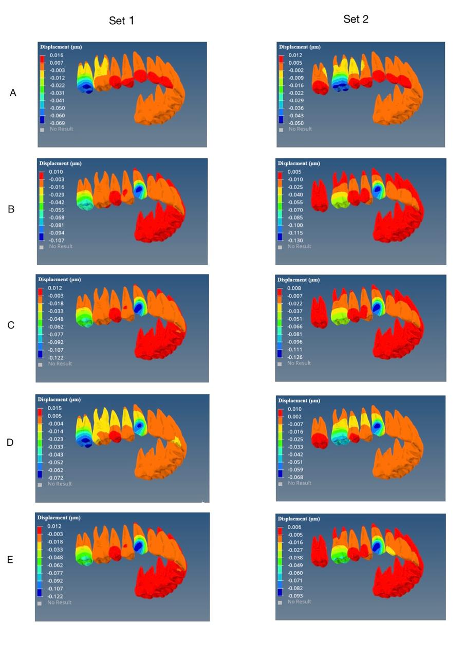 Colour map for movement tendency of the maxillary molars in Z-axis in Models of Set 1 and Set 2. The global coordinate system was established by considering the complete dentition. The red colour shows maximum displacement areas and the blue colour shows minimum displacement areas. The positive value represents distal movement and the negative value represents mesial movement.