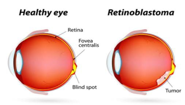 Differnce between helthy eye and tumor eye