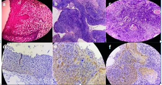 Histopathological section showing (a) LSIL, (b) HSIL & (c) SCC (H&E, x4), IHC expression of p16INK4a in (d) LSIL, (e) HSIL & (f) SCC (p16, x4)