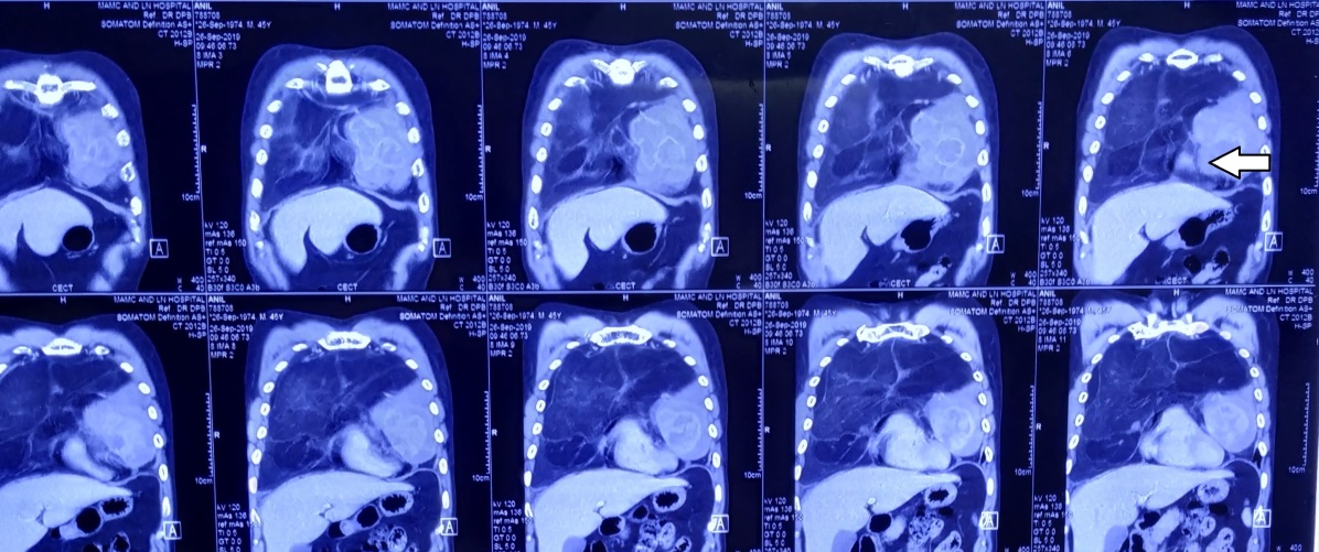 MRI- showing anterior mediastinal mass
