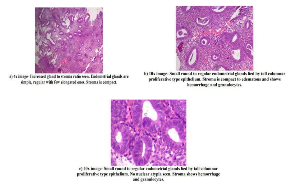Histopathological Study of Endometrium in Patients with Dysfunctional Uterine Bleeding with Emphasis on Progesterone Receptor Expression in Cases of Endometrial Hyperplasias and Carcinomas