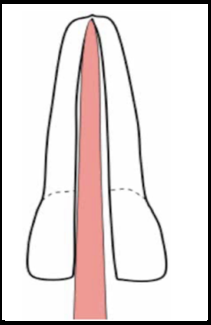 Single cone obturation. Voids around the GP necessitate a greater dependency on sealer
