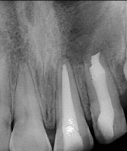 Obturation of blunderbluss canals