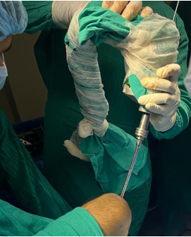 Reaming of tibial canal with flexible reamer and using an electric drill due to cannulation.