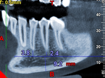 CBCT image showing the horizontal location of MFand its vertical distances from inferior border of mandible, and from the apex of first and second premolar.