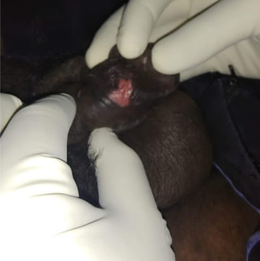 Genital ulcer in primary syphilis - HIV coinfection