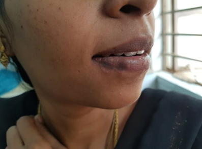 Syphilid plaques in lower lip