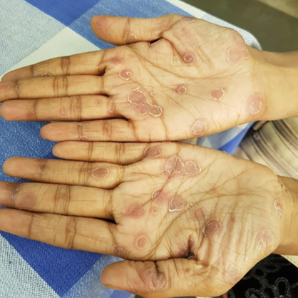 Palmar syphilis in a secondary syphilitic male