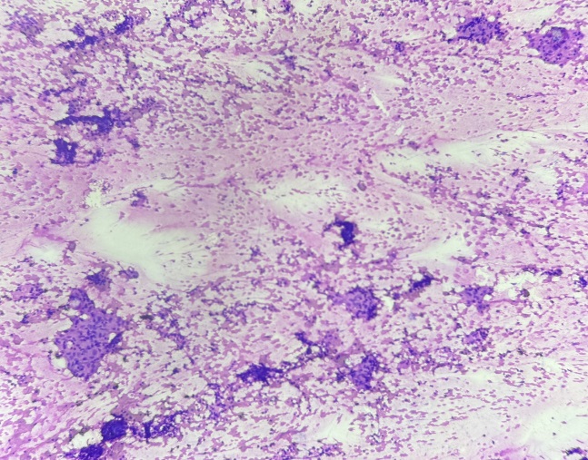 Granlomas showing epithelioid cells, lymphocytes in necro-haemorrhagic background (10x)