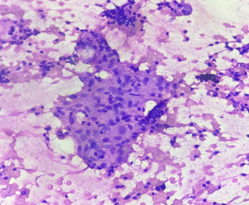 Granuloma showing epithelioid cells and lymphocytes (40x)