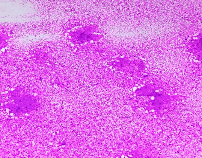 Caseous necrosis material (H and E stain 10x)