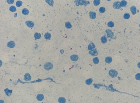 ZN stain showing slender beaded bacilli. (Oil immersion)