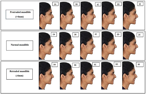 Three sets of altered images with different mandibular positions and maxillary incisors inclination in female.