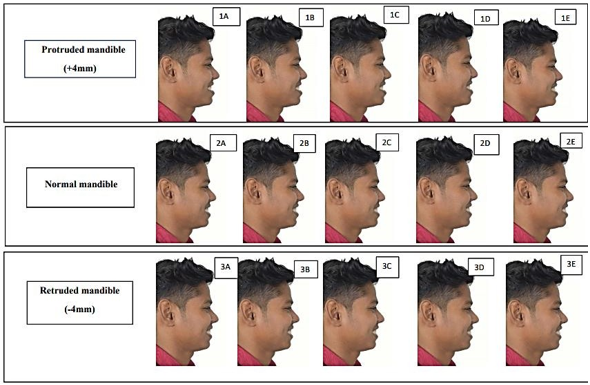 Three sets of altered images with different mandibular positions and maxillary incisors inclination in male.