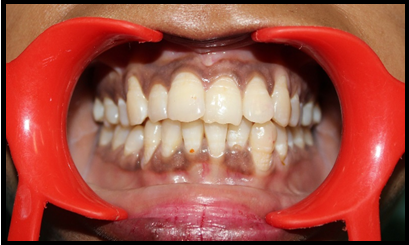Pigmentation on both maxillary and mandibular gingiva.