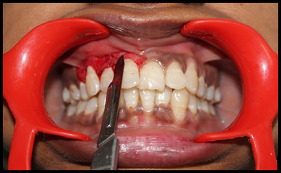 Removal of pigmented layer using scalpel.