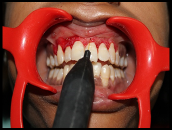 Contact of laser tip with pigmented tissue.