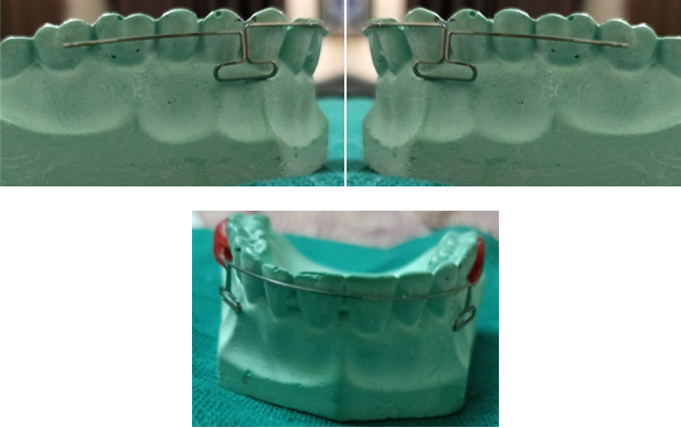 Segmental T Loop