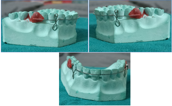 Pg Retraction Spring