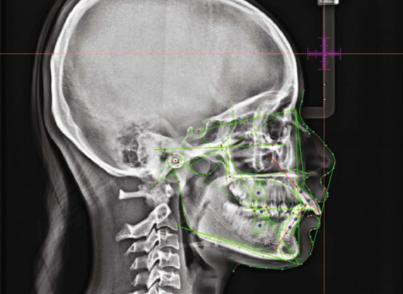 Prediction of cephalometric landmarks using artificial intelligence.3