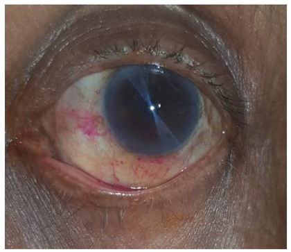 Rose bengal staining in the nasal and inferior bulbar conjunctiva