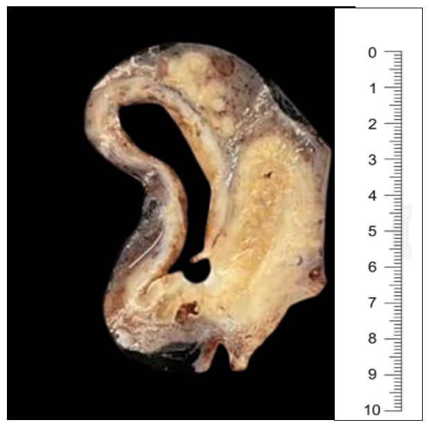 Xanthogranulomatous Oophoritis: A Rare Inflammatory Enigma of the Ovary