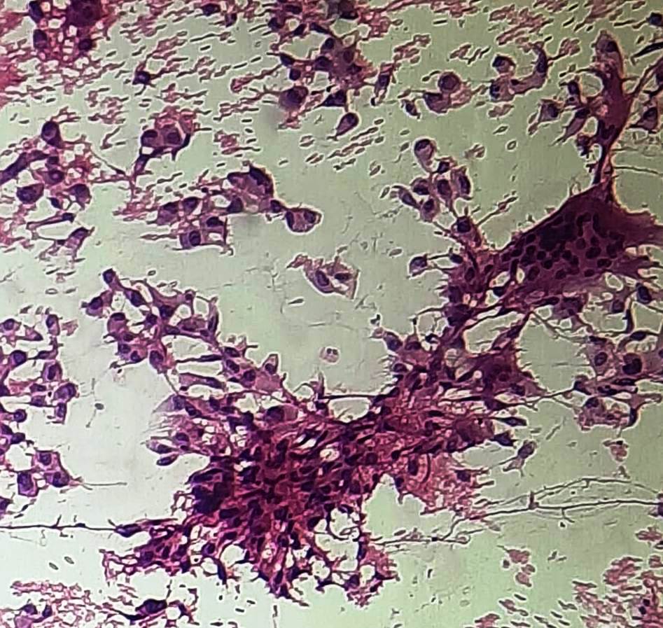 Cytomorphology of Anaplastic thyroid carcinoma with giant cells (H&E,x200)