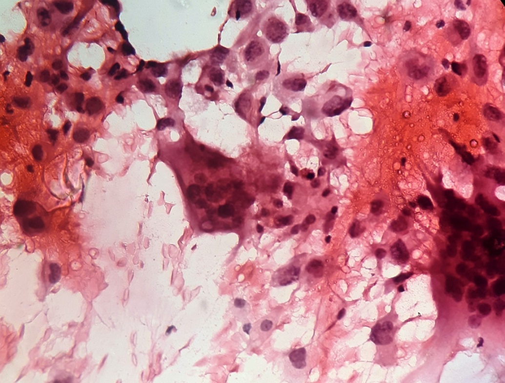 Light microscopy of individual malignant cells with multinucleated giant cells on cytology (Pap,x400)