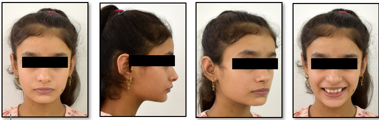 Pretreatment extraoral photographs
