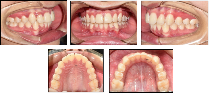Post treatment intraoral photographs