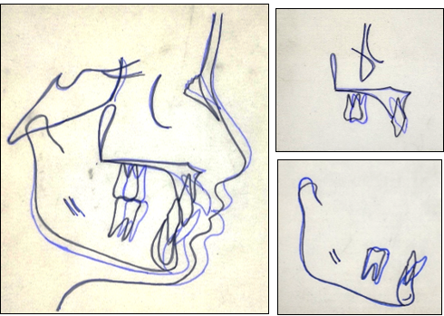 Cephalometric super imposition