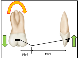 Off-centered V bend (at one-third distance from molar tube)