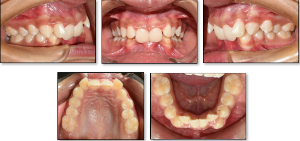 Pretreatment intraoral photographs