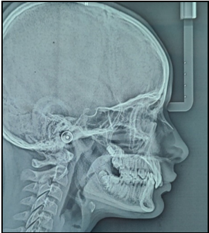 Lateral cephalogram (Pretreatment)