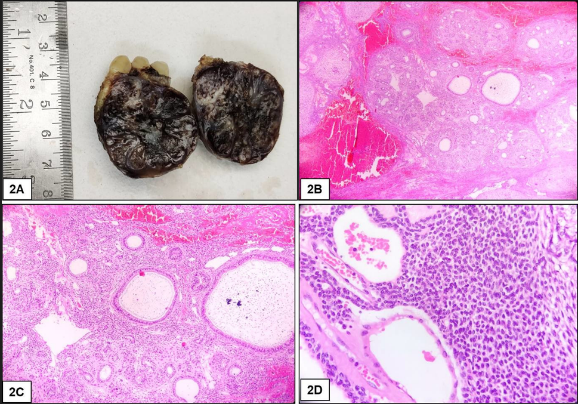 A:) Excised specimen cut section shows solid and cystic areas and a thin capsule. B): Photomicrograph showing encapsulated tumor with solid, cystic and hemorrhagic areas. (HE 40x) C): Photomicrograph showing tumor composed of cells arranged in solid nodules, rosettes or duct like structures and plexiform strands at periphery. (HE 100x) D): Photomicrograph showing tumor composed of variable nodules of spindle, cuboidal and columnar epithelial odontogenic cells. (HE 400x)