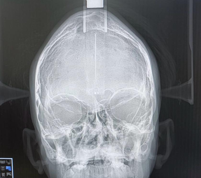 PA skull