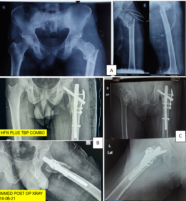 A): Patient with associated head treated after remaining on ventilator 8 days, B): HFN plus TBP combo and Immediate post operative X-ray, C): X-ray image after 17 months followup