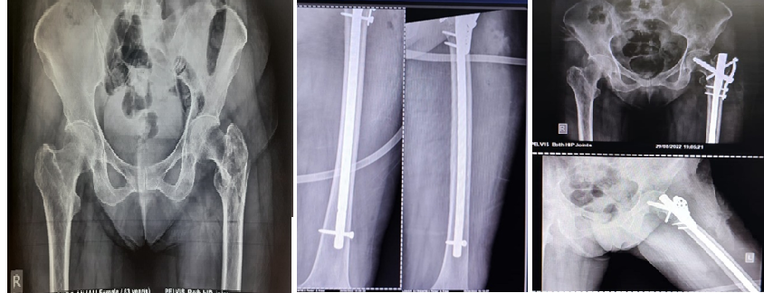X-ray image showing osteoporotic bone and thin lateral wall and Long HFN and trochanteric buttress plate.