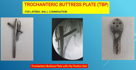 Dr Ganjale’s Hip Fixation Nail and Trochanteric buttress plate