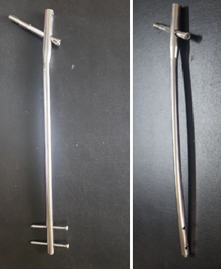 Long Hip Fixation Nail has anatomical curvature as per femur shaft for trochanteric fractures associated with subtrochantric fractures and Segmental fracture shaft femur.