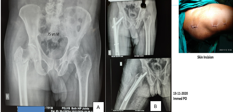 Patient X–ray images A): Pre-operative images, B): post- operative x-ray and skin incision images