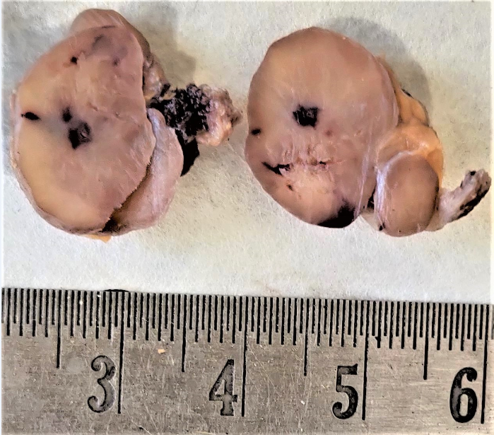 Gross Examination: Cut section of the excised mass show homogenous grey-white area with hemorrhagic foci.