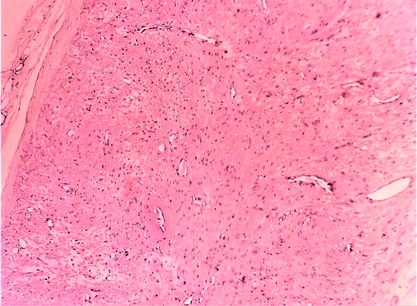 Photomicrograph showing encapsulated well circumscribed lesion composed of fascicles of loosely compact mature smooth muscle cells surrounding variable sized vascular channels (H&Ex40).