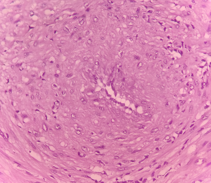 Photomicrograph showing perivascular proliferation of smooth muscle cells (H&Ex400).