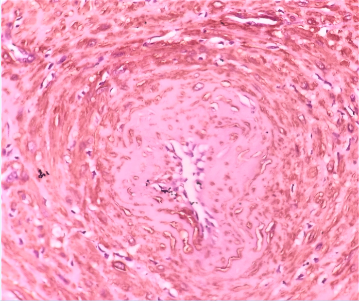 Photomicrograph of the corresponding area as of Fig-3 showing strong membranous and cytoplasmic positivity of smooth muscle actin (SMA)in the perivascular smooth muscle cells (IHC, SMAx400)