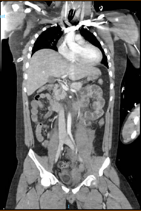Initial CT of the chest, abdomen, and pelvis upon admission.
